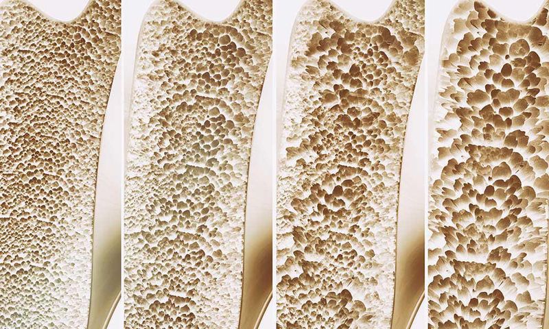 Osteoporóza